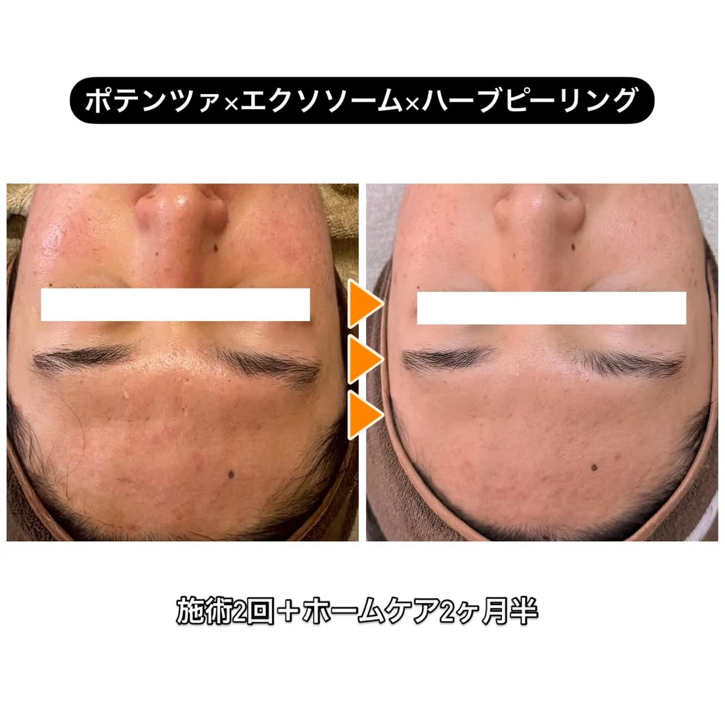 ꧁꒰ঌ˙˚ポテンツァ×エクソソーム×ハーブピーリング˚˙໒꒱...