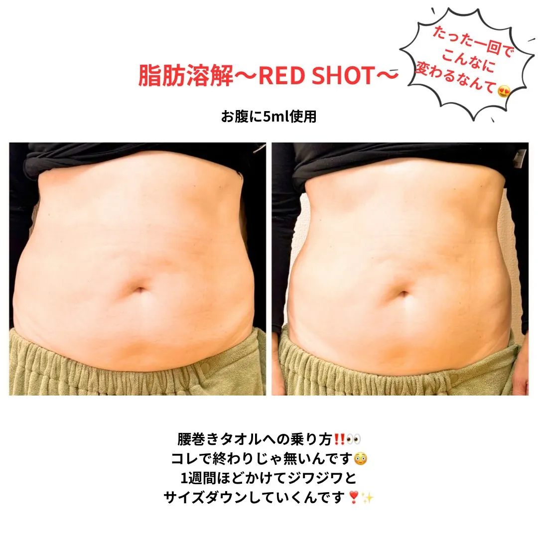 ✨脂肪溶解《RED SHOT》✨