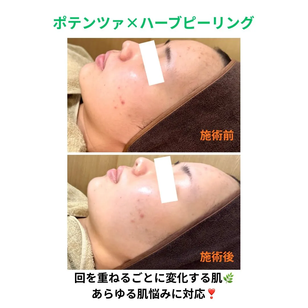 【ポテンツァ × ハーブピーリング🌿】