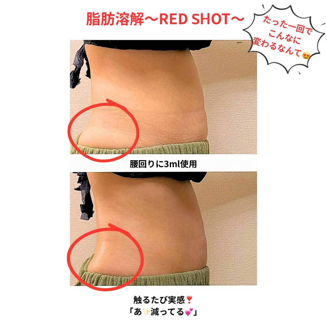 たった1回、施術前後の比較写真📷