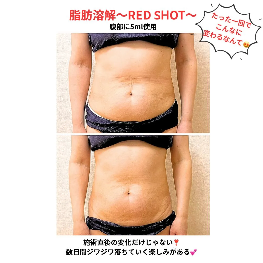 🔥脂肪溶解 〜RED SHOT〜🔥